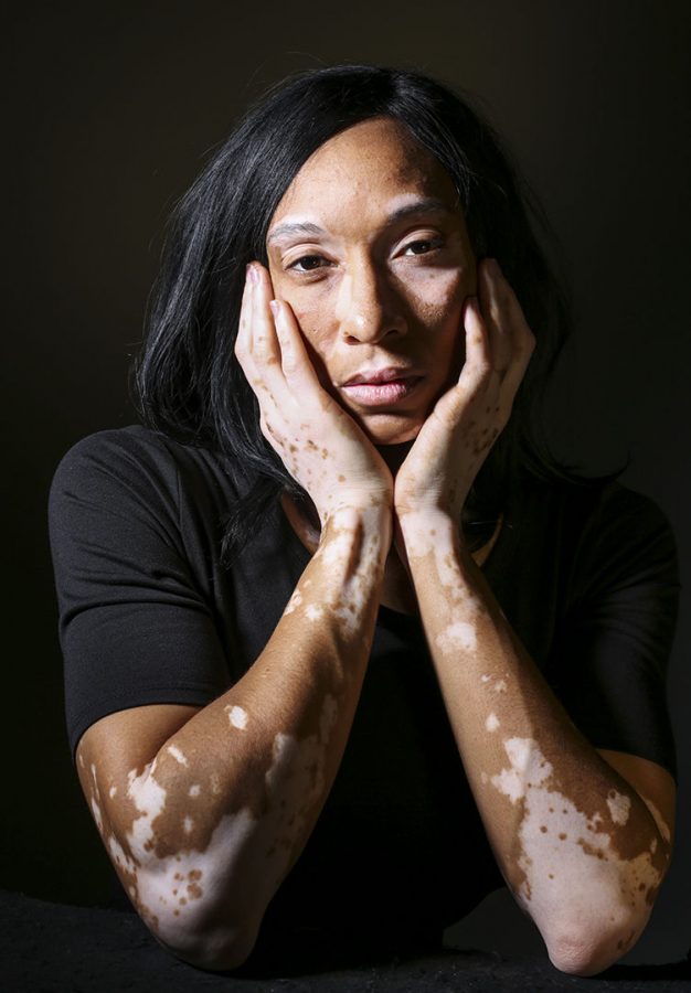 Brittany LaRue noticed her vitiligo when she was 18-years-old. She’s 34 now. LaRue has been called a cheetah, cashiers don’t want to touch her hand when she pays in cash and she was even asked had she been burned. She was depressed for 10 years, but finally gained confidence in 2012 after going to a conference for vitiligo in Clearwater, Florida. “I made myself pack shorts, tank tops and other clothes that wouldn’t cover me up. I just wanted to be me again and after that weekend I was,” she said.