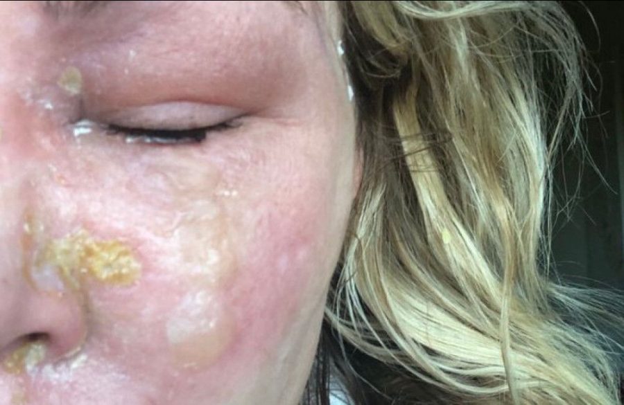 Brandi Glanville shares photos of painful facial burns